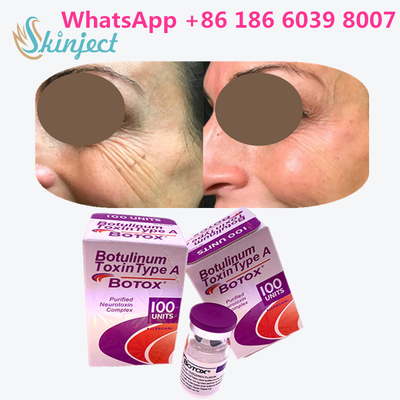 बोटुलिनम विष Allergan  100 Iu 200ui 1 शीशी / बॉक्स