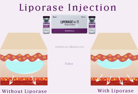 भंग करने के लिए त्वचीय भराव के लिए 10 Vias लिपोरेज Hyaluronidase
