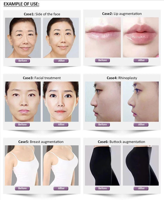 चेहरे के लिए 1.1 मिली रिवोलैक्स डीप हाइलूरोनिक डर्मल फिलर
