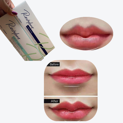 2*1ml/Box Cross Linked Dermal Filler For Lips Augmentation 2*1ml/Box होंठ बढ़ाने के लिए क्रॉस लिंक्ड डर्मल फिलर