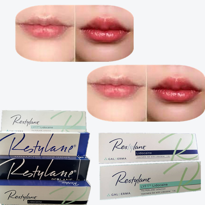 2*1ml/Box Cross Linked Dermal Filler For Lips Augmentation 2*1ml/Box होंठ बढ़ाने के लिए क्रॉस लिंक्ड डर्मल फिलर