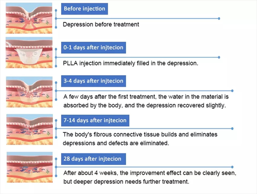 PLLA पॉली- एल- लैक्टिक एसिड फेशियल इंजेक्शन 10 फ्लायल 150mg