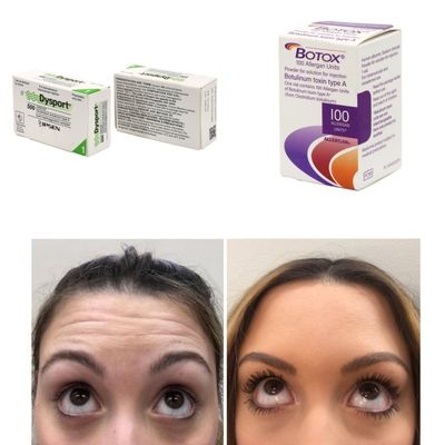 100 यूनिट कोरिया बीटीएक्स बोटुलिनम टॉक्सिन झुर्रियों और महीन रेखाओं के लिए