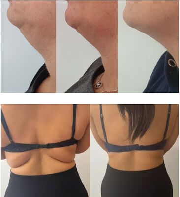 नींबू की बोतल वसा भंग करने वाले इंजेक्शन लिपोलिटिक समाधान