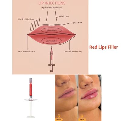 अनुकूलन 1ml 24mg/Ml रेड लिप फिलर इंजेक्शन लिप इंजेक्शन