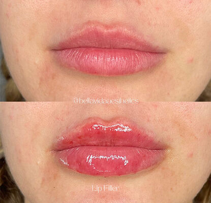 2 साल की शेल्फ लाइफ डर्मल फिलर इंजेक्टेबल जेल जो झुर्रियों को कम करने, चेहरे को आकार देने और त्वचा को फिर से जीवंत करने के लिए डिज़ाइन किया गया है