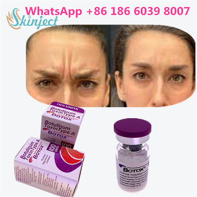 बोटुलिनम विषाक्त पदार्थ बोटॉक्स सौंदर्य प्रसाधन 100 इकाइयां चेहरे की झुर्रियों के लिए एलर्गेन ओनाबोटुलिनम विषाक्त पदार्थ