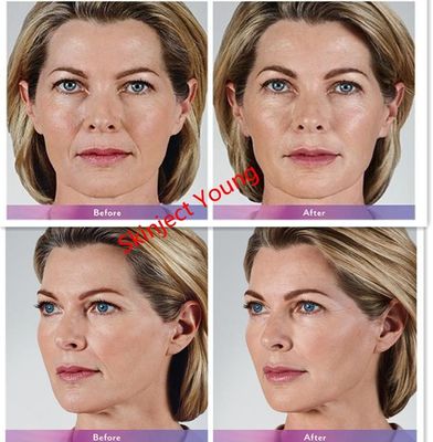 Juvederm Voluma 2x1ml हयालूरोनिक एसिड इंजेक्टेबल जेल फिलर्स