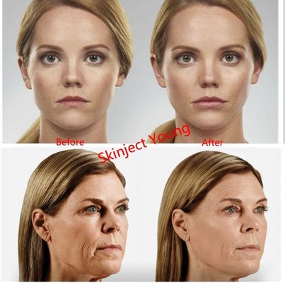 Juvederm Voluma 2x1ml हयालूरोनिक एसिड इंजेक्टेबल जेल फिलर्स