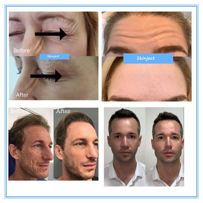 Hyamely Botax शिकन हटाने इंजेक्शन 100 इकाइयों बोटुलिनम विष सौंदर्य