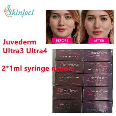 Juvederm Hyaluronic एसिड डर्मल फिलर Juvederm लिप फिलर  2x1ml Ultra3 Ultra4 के साथ