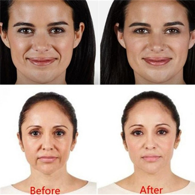 हा 2ml त्वचीय भराव होंठ इंजेक्शन शिकन भराव इंजेक्शन Juvederm