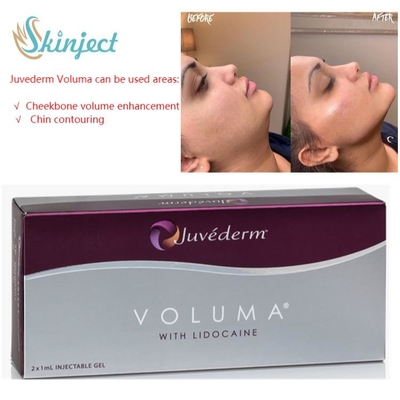 चीकबोन के लिए Juvederm Voluma 2x1ml हयालूरोनिक एसिड डर्मल फिलर्स
