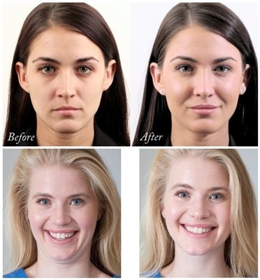 Juvederm Voluma Hyaluronic एसिड फेशियल फिलर 24 Mg/Ml . अपग्रेड करें