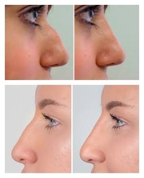 ठोड़ी और गाल वृद्धि के लिए Juvederms Voluma Hyaluronic एसिड फेशियल फिलर