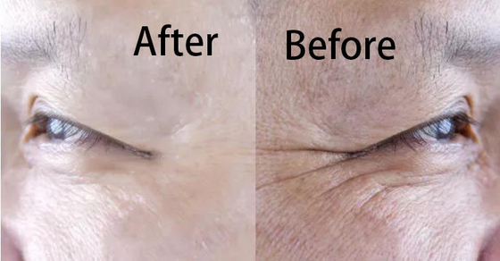 Hyaluronic एसिड फिलर कोलेजन पुनर्जनन व्हाइटनिंग और एंटी एजिंग इंजेक्शन