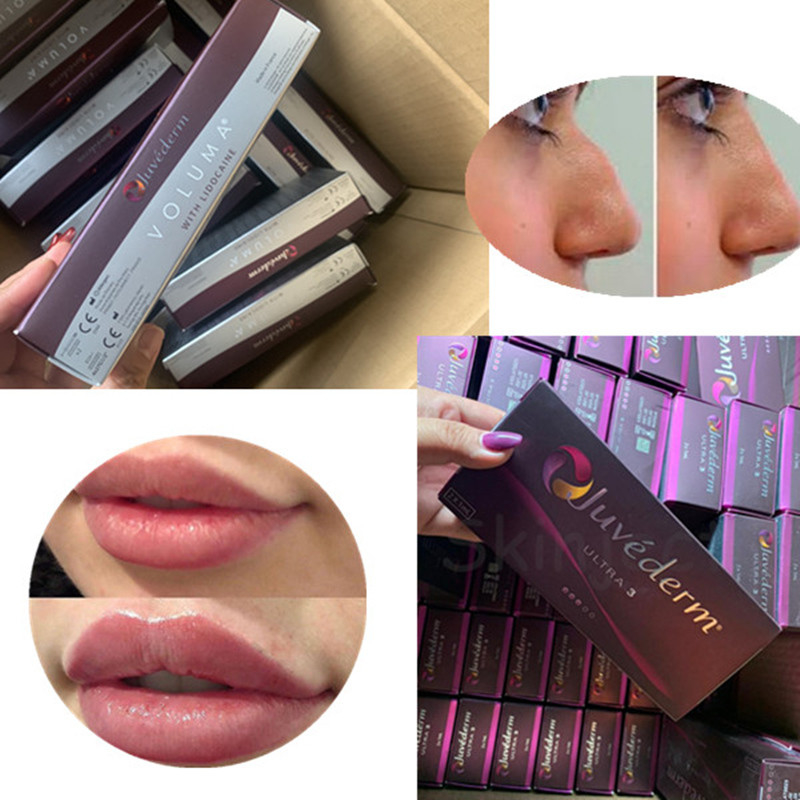सेक्सी होंठों को बढ़ाने के लिए 2 ML Juvederm Ultra 4 Hyaluronic एसिड डर्मल फिलर