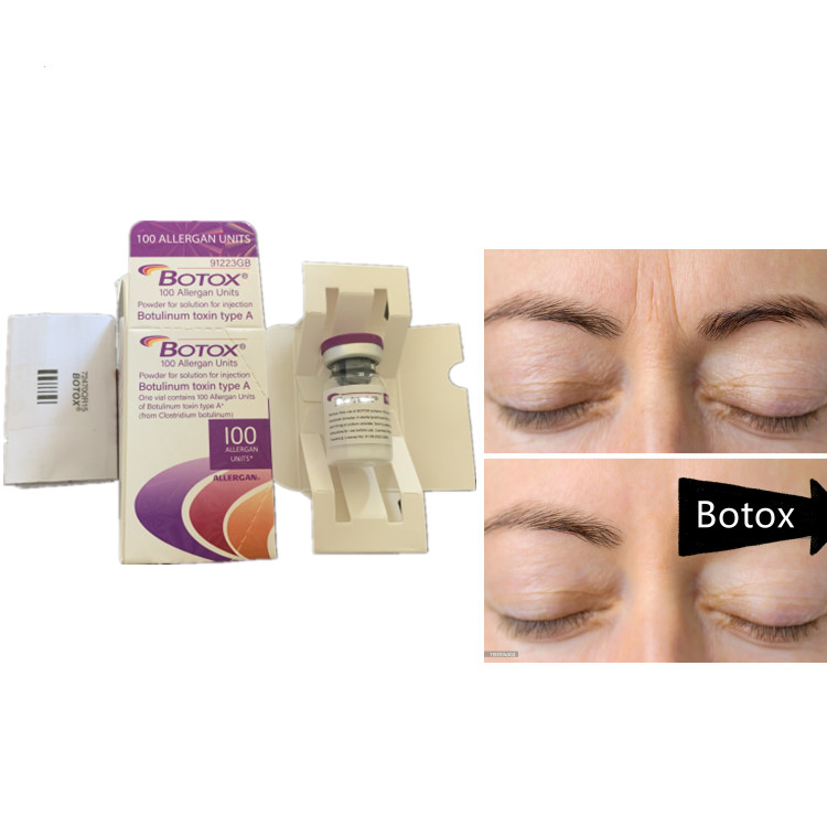 Allergan 100ui बोटुलिनम विषाक्तता सीरम चेहरे के विकार के लिए एंटी एजिंग उत्पाद