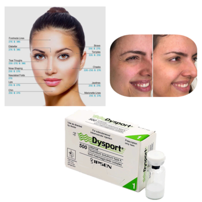 झुर्रियों के उपचार के लिए Dysport 500U बोटुलिनम विष टाइप ए